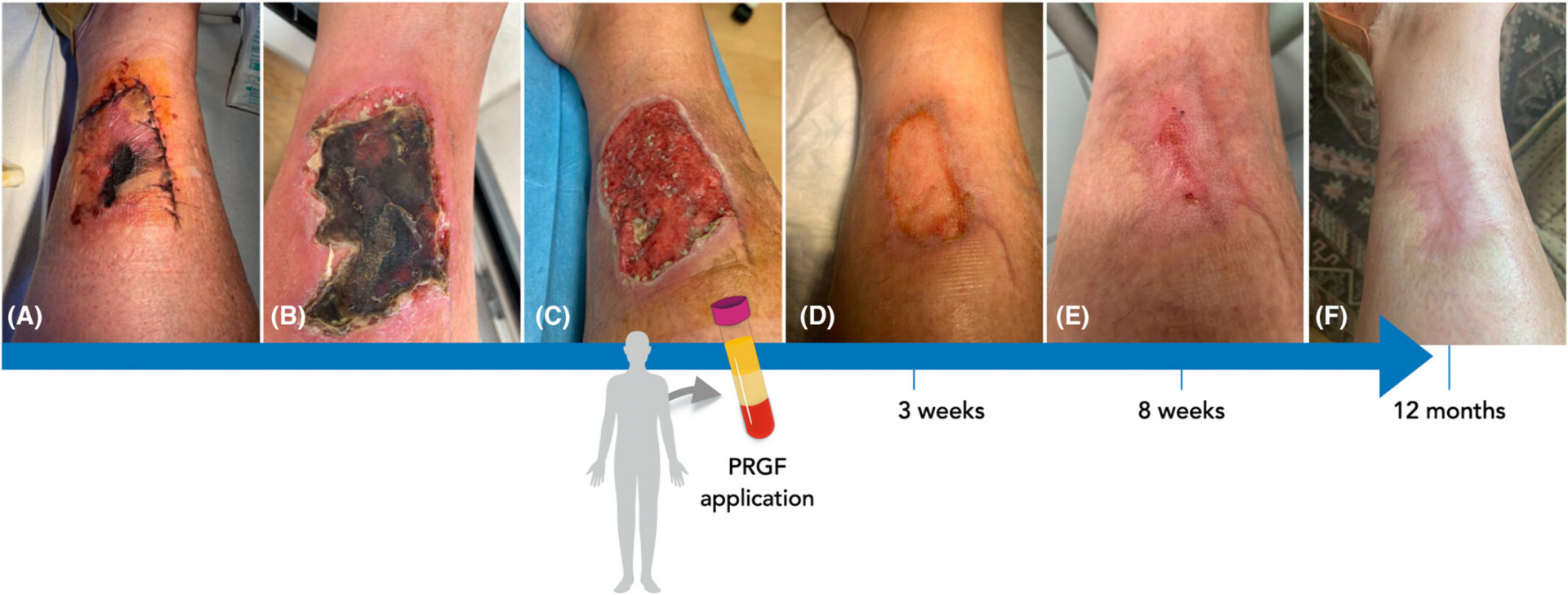 Clinical timeline showing wound healing progression after PRP application at 3 weeks, 8 weeks, and 12 months